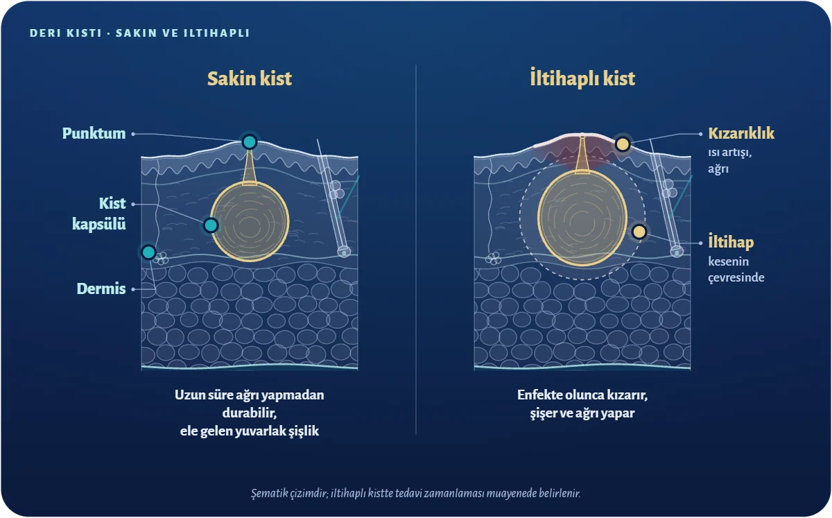 İltihaplı kist sakin kistten nasıl ayrılır