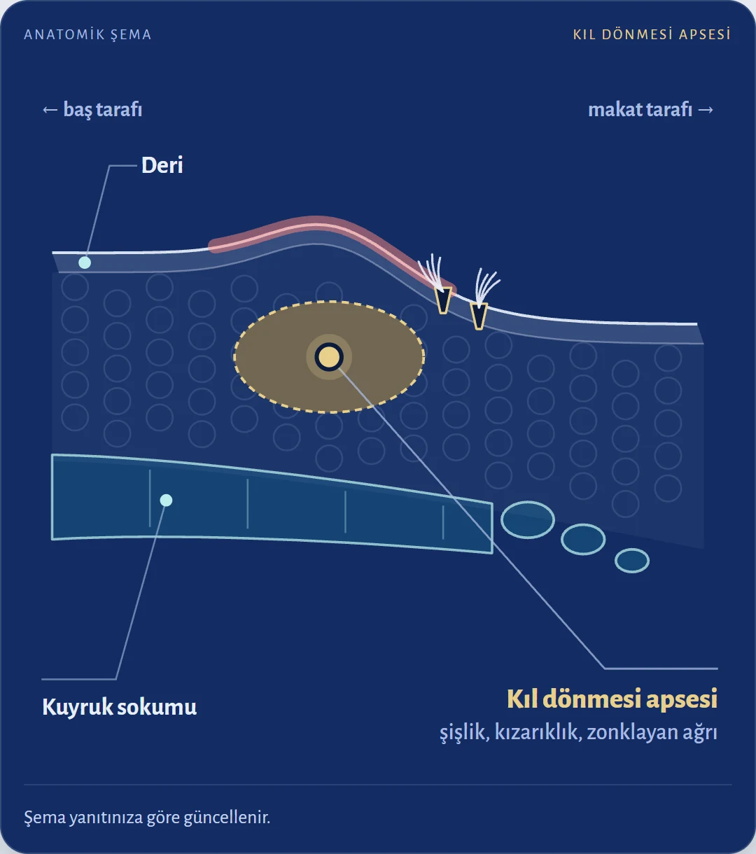 Kuyruk sokumunda ağrılı şişlik kıl dönmesi apsesi mi