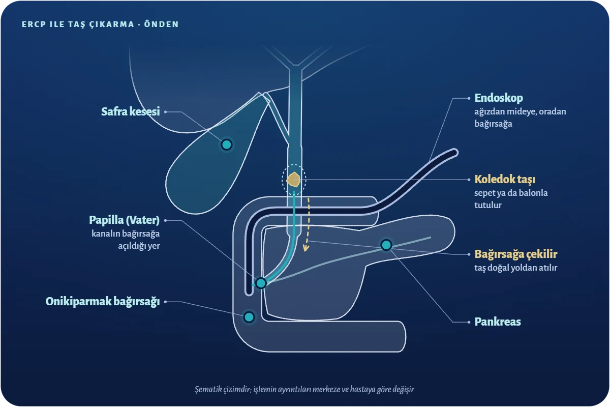 ERCP nedir nasıl yapılır
