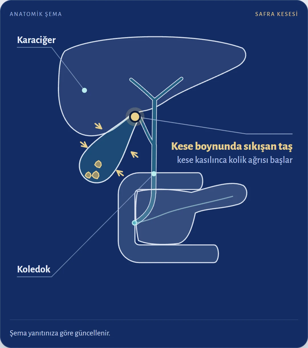 Safra kesesi ağrısı neden olur